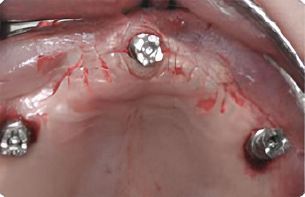 抜歯当日にインプラント体を埋入