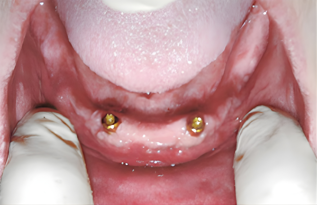 支えになるインプラントを埋入