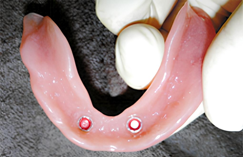 インプラントの上から着ける入れ歯