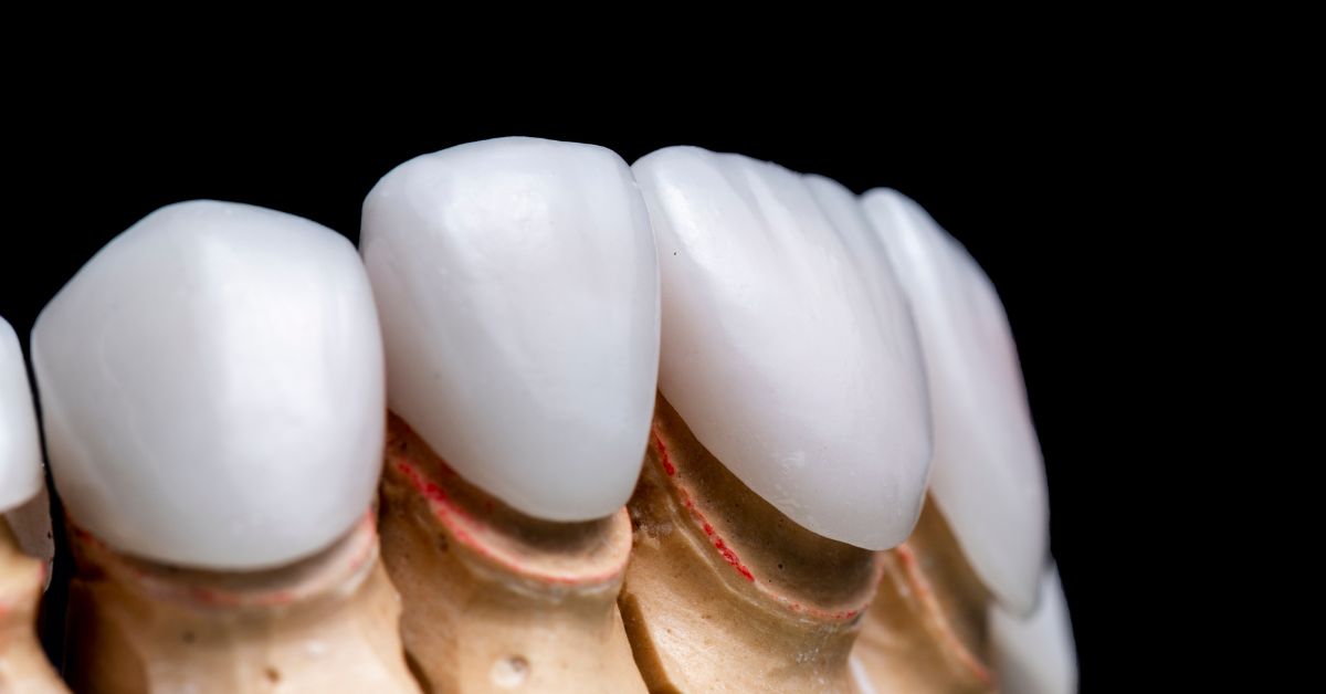 ③ 上部構造（被せ物）の素材