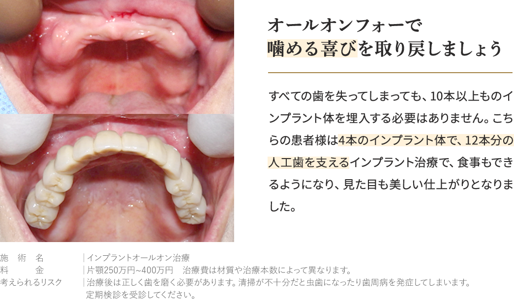 All-on-４とは…