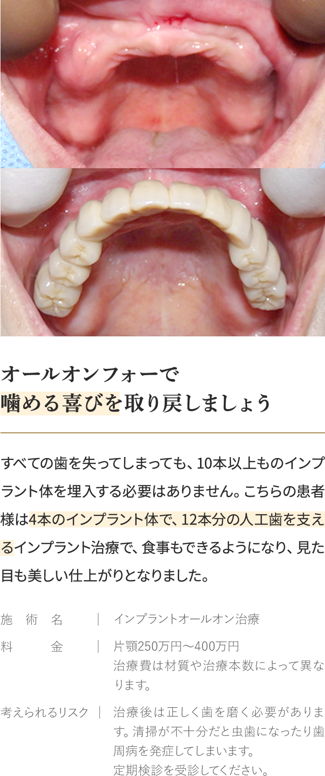 All-on-４とは…