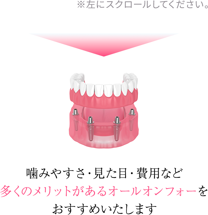 オールオンフォーは他の治療に比べ患者様の負担の軽減が可能な治療です