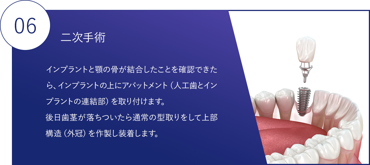 06.インプラントの上に人口歯と連結部を取り付ける処置を行います。