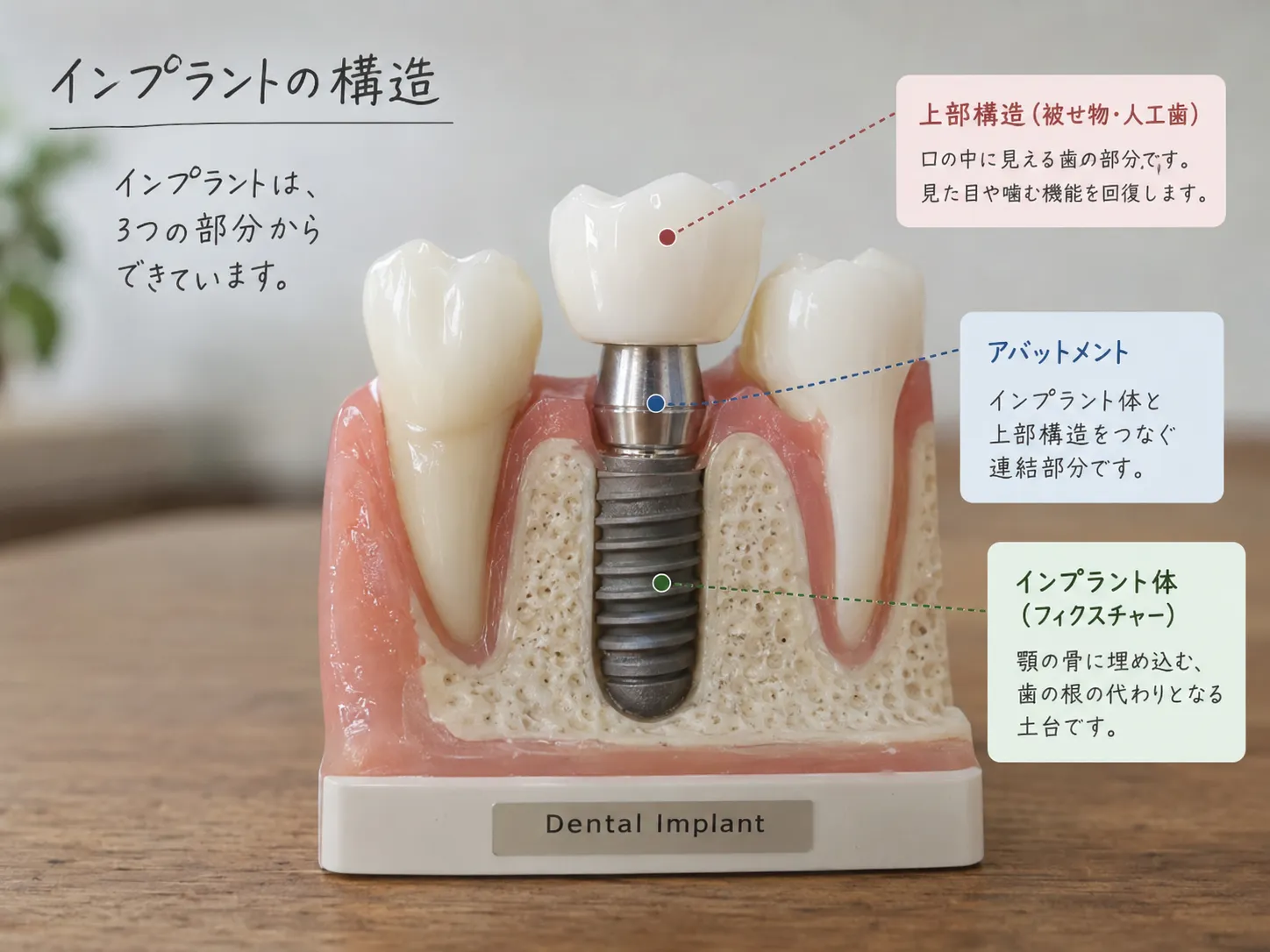 インプラントを構成する3つの部品