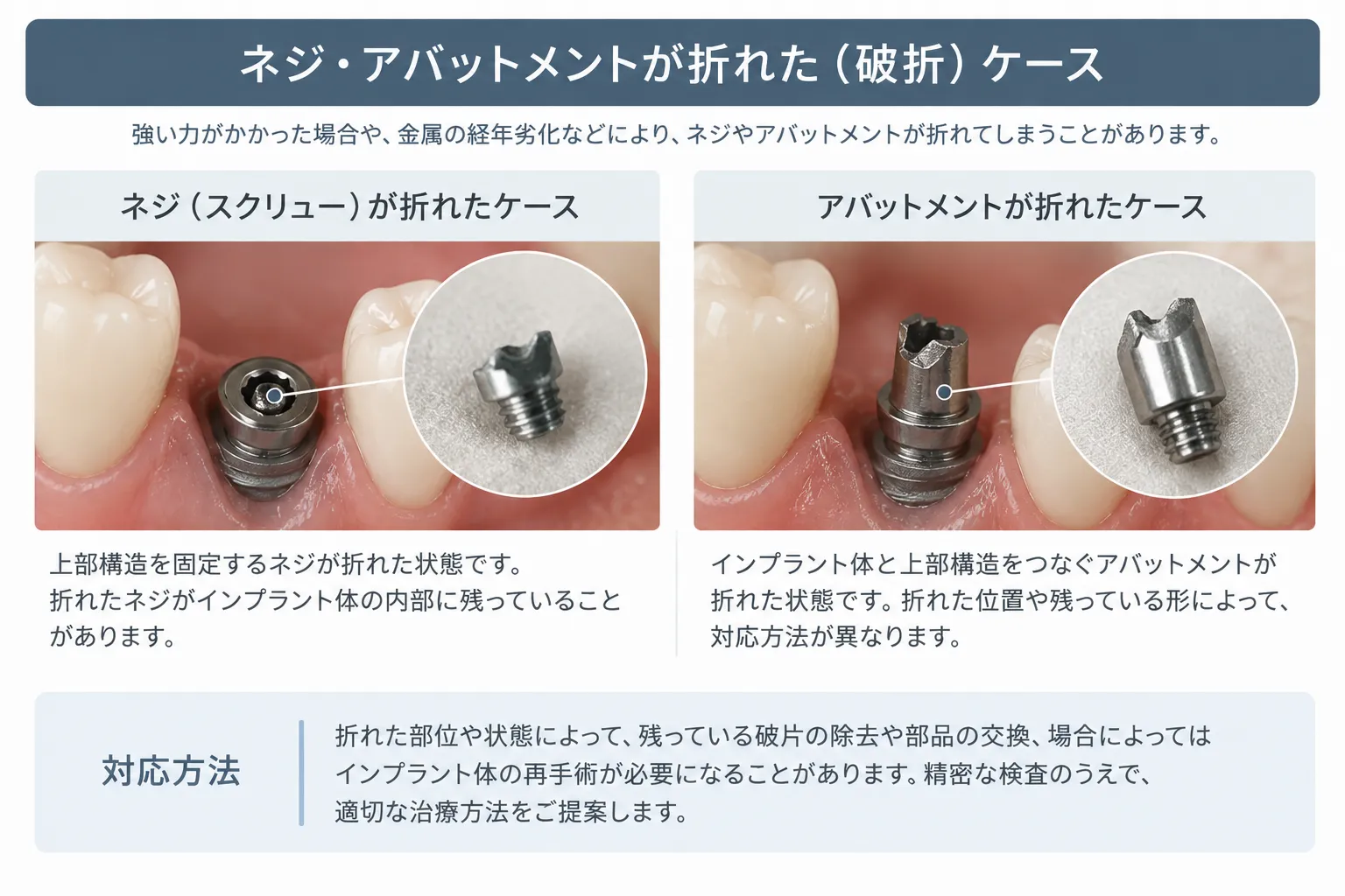 ネジ・アバットメントが折れた（破折）ケース