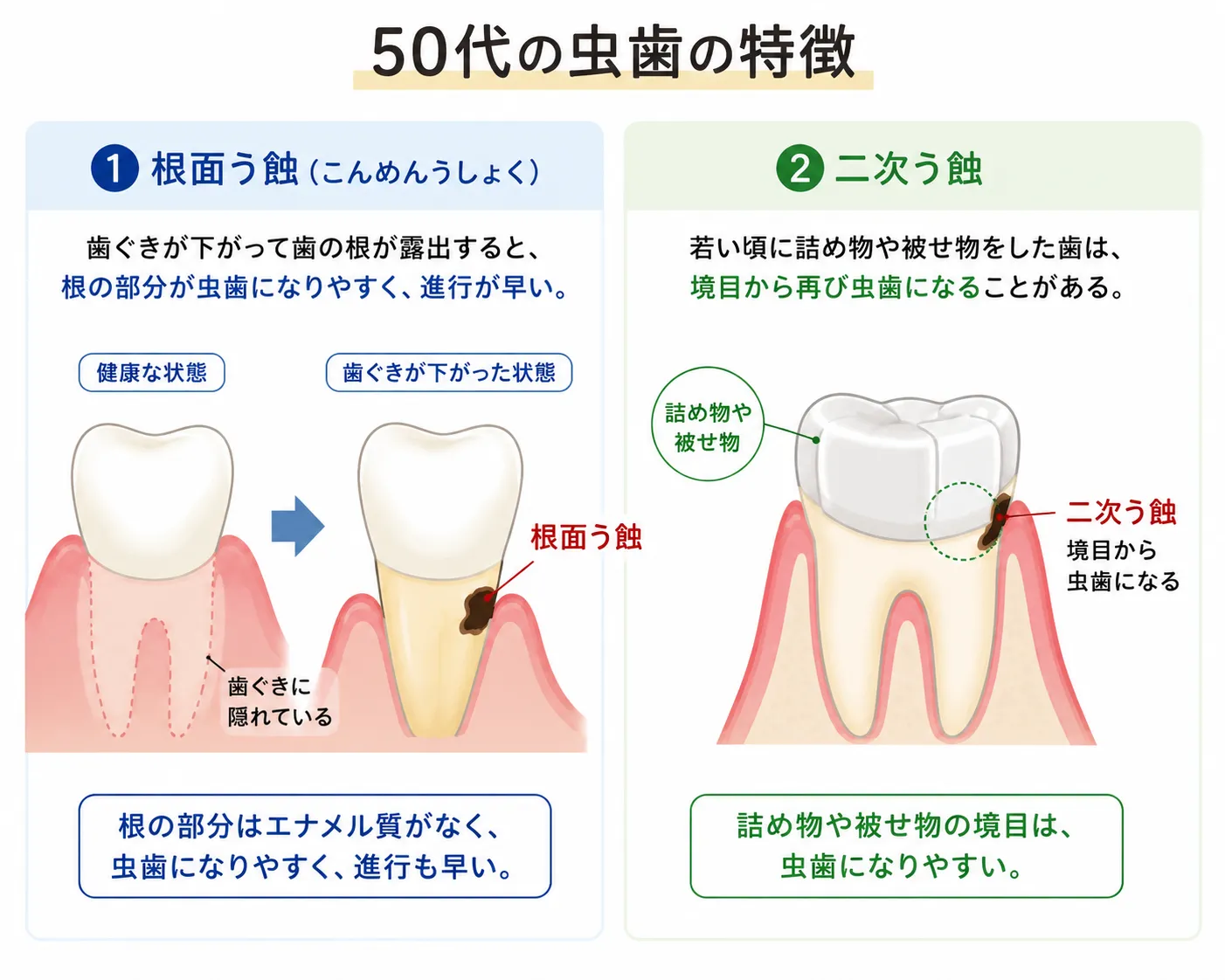 原因①虫歯(根面う蝕・二次う蝕)