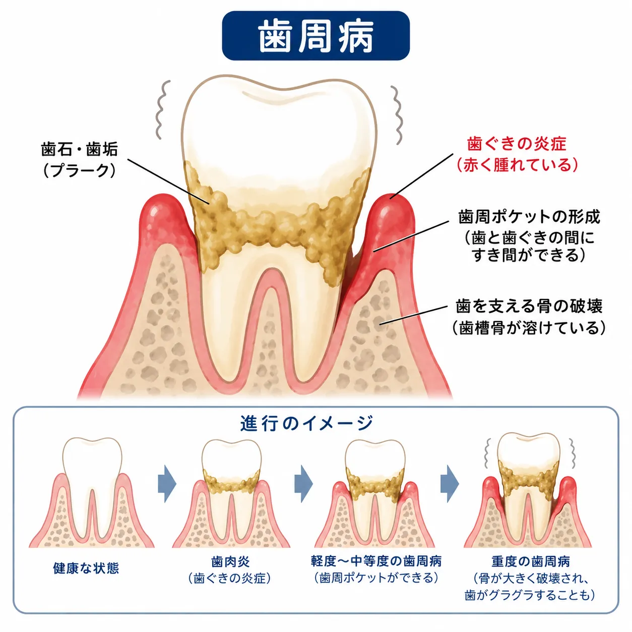原因②歯周病(歯を支える骨が溶ける)