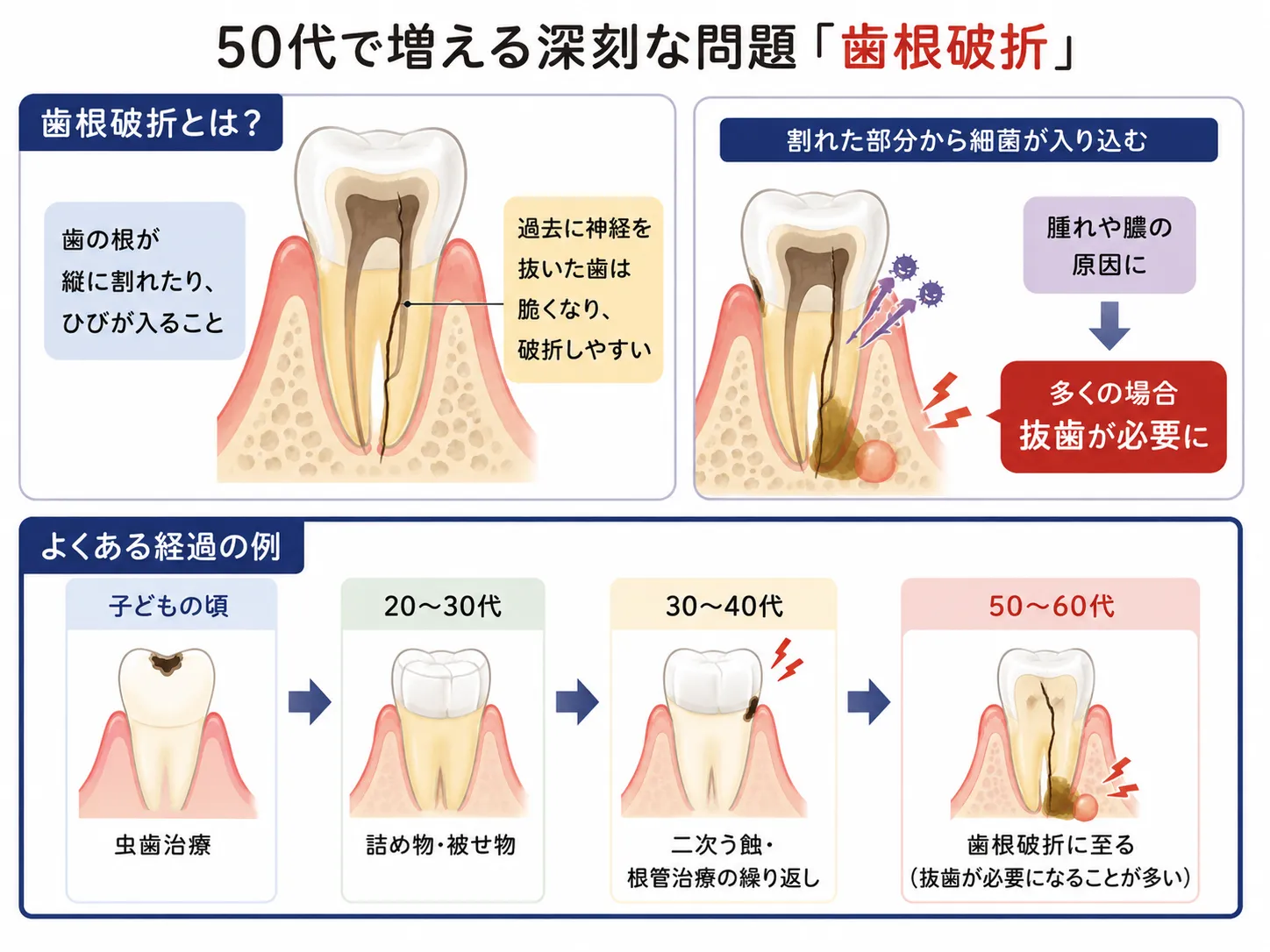 原因③歯根破折(しこんはせつ)