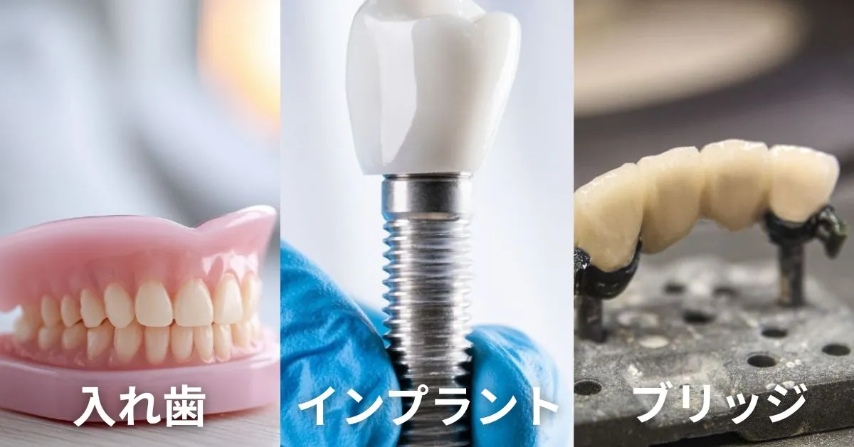 インプラント・入れ歯・ブリッジの違いを一覧で比較