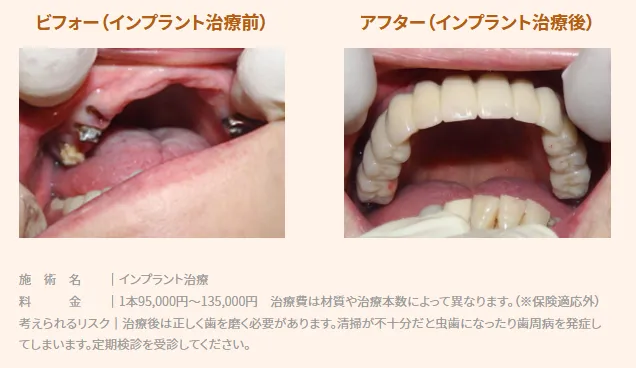 虫歯で多くの歯が根だけになっていた症例