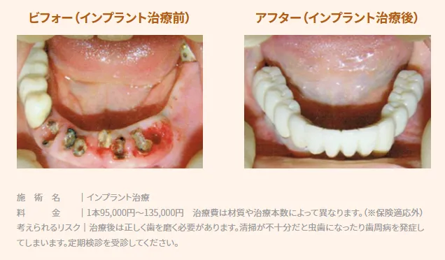 歯周病で歯がグラグラしていた症例