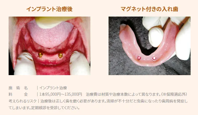 入れ歯が安定しなかった症例