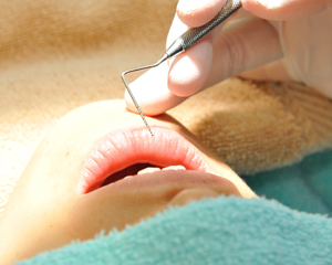 ③プローブで歯茎の状態を測る器具でインプラント本体と歯茎の隙間を検査します