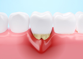 歯周病（歯槽膿漏）がひどく進行している場合