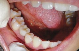 失った1本の歯をインプラントで補った症例