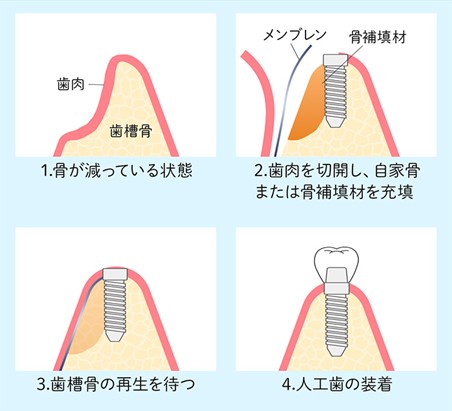 GUIDED BONE REGENERATION（GBR）：骨誘導再生法