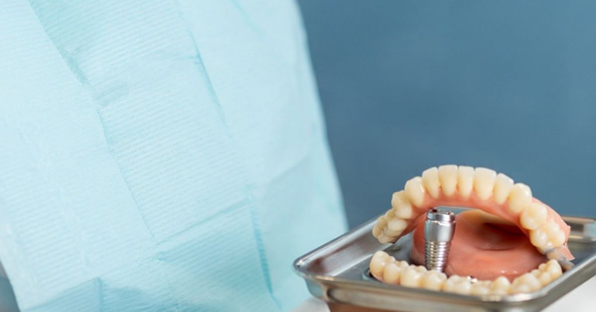 インプラント費用の内訳|診断・手術費から人工歯まで