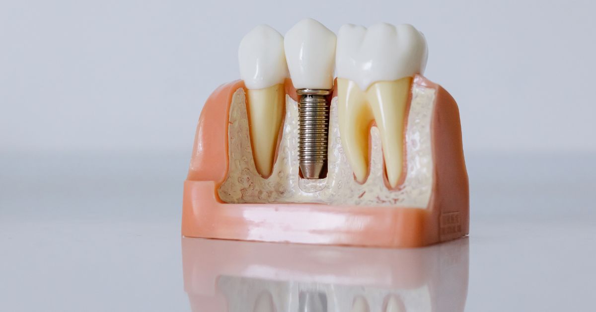 【最新】インプラントの相場はどれぐらい?|1本の費用目安・内訳・費用を抑える方法を解説