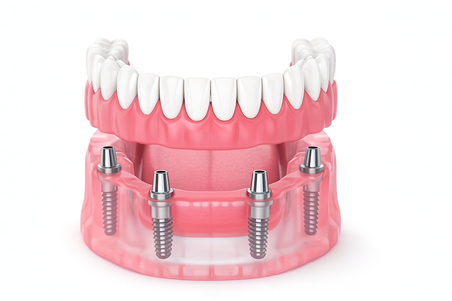 【All-on-4(オールオンフォー)】最小限の本数(4本)で全ての歯を支える技術