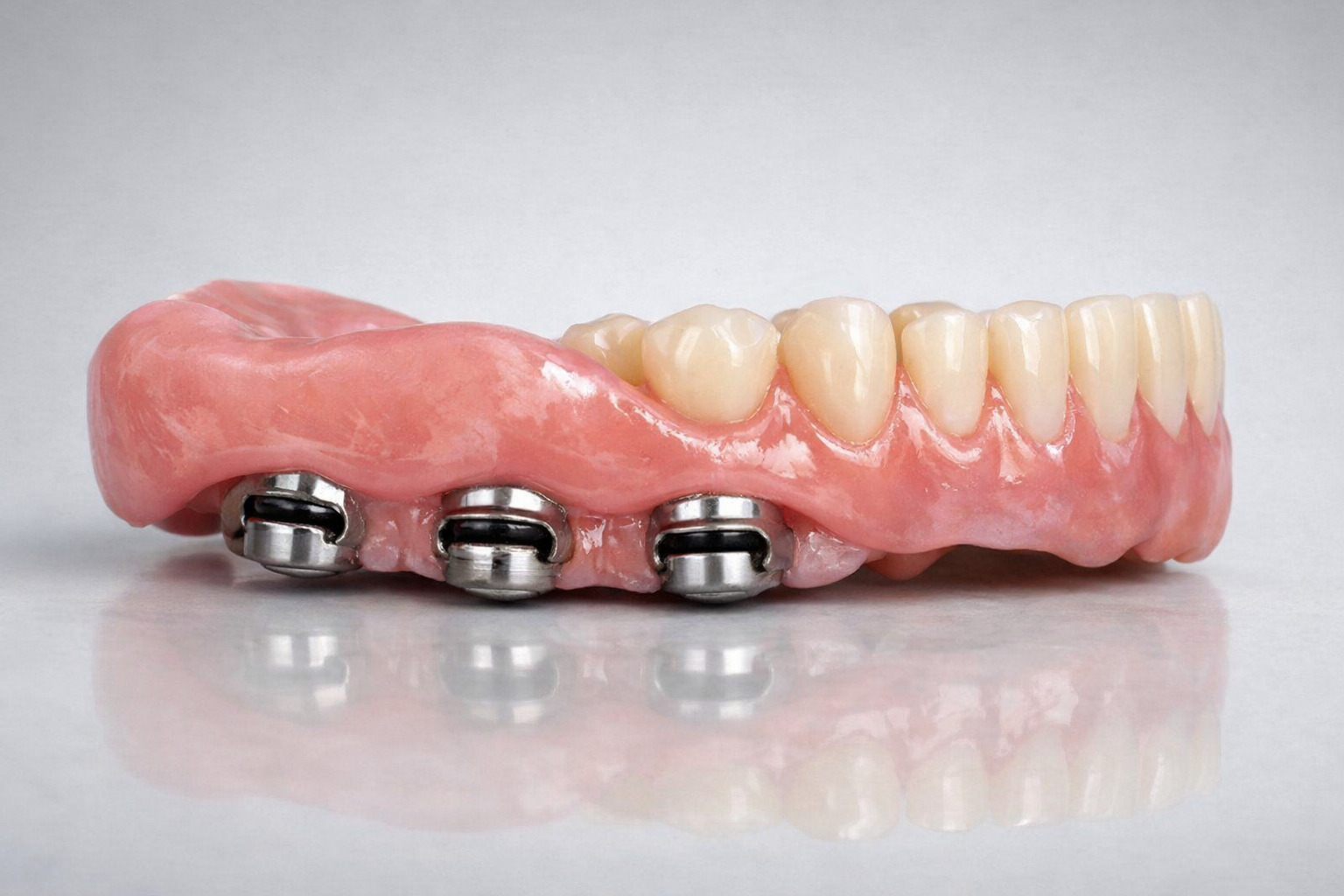 ②【着脱式】インプラントオーバーデンチャー