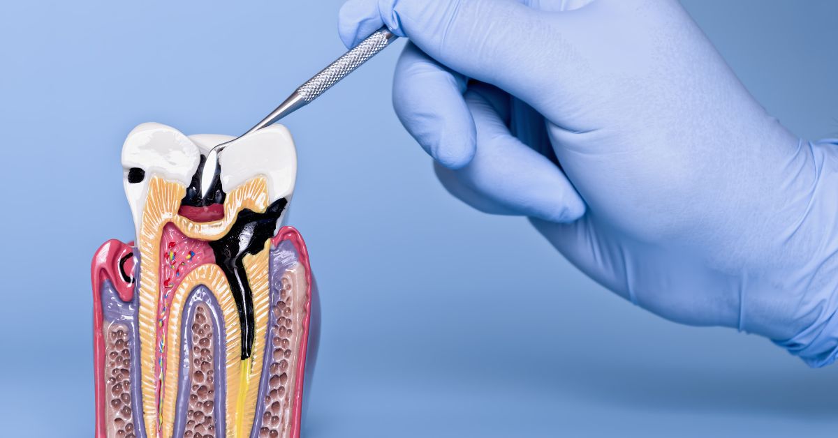1. インプラントの前に歯周病を完治・コントロールする