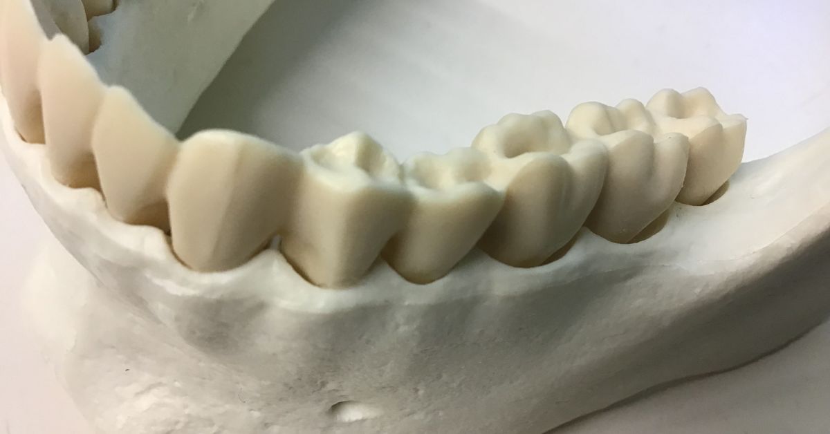 ステップ2：不足している骨を増やす再生治療（GBR・ソケットリフト）