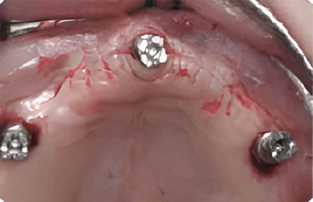 抜歯当日にインプラント体を埋入