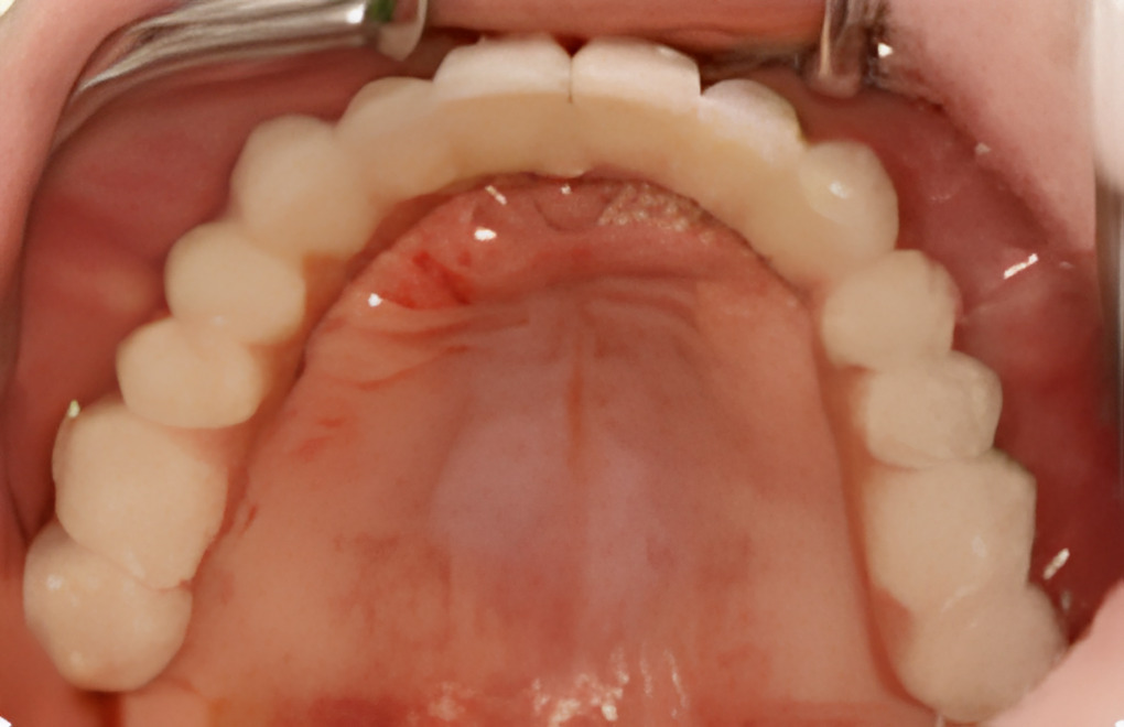 インプラント体に仮歯を接着