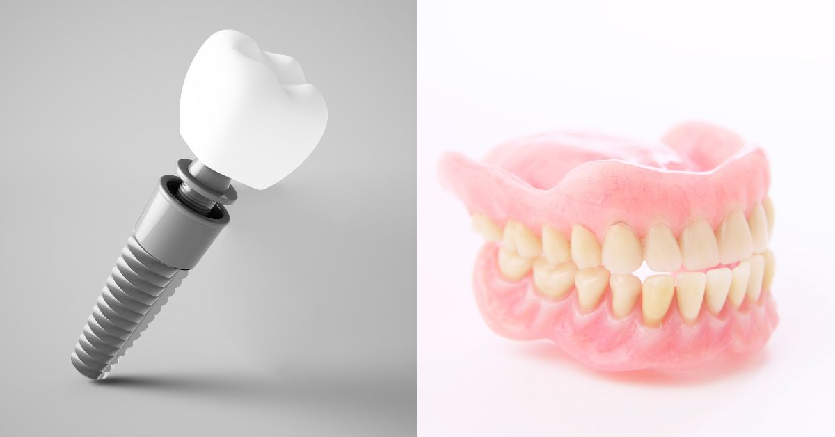 【結論】インプラントと入れ歯、結局どちらがいい?